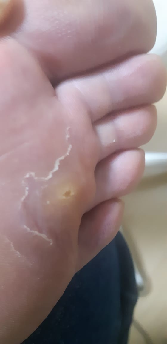 Мозоль. Подолог г. Хабаровск — центр здоровой стопы «FOOTTIME»