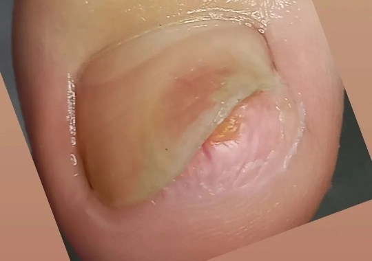 Экзостоз у девочки 13 лет. Подолог г. Хабаровск — центр здоровой стопы «FOOTTIME»