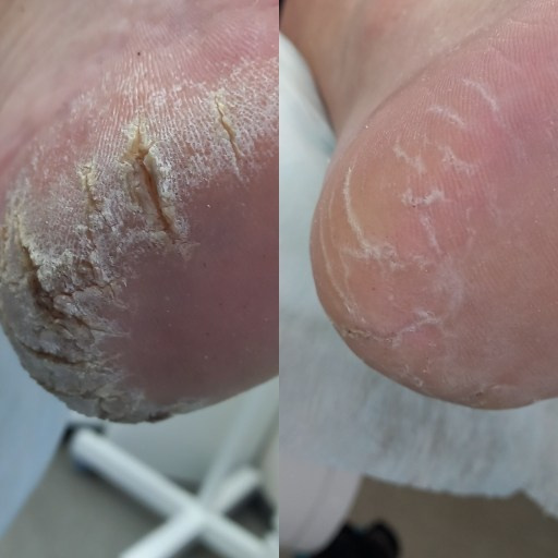 Обработка трещин. Подолог г. Хабаровск — центр здоровой стопы «FOOTTIME»