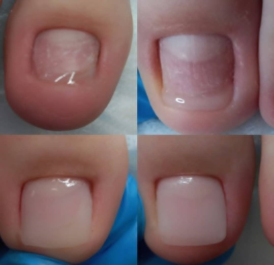 Протезирование ногтя. Подолог г. Хабаровск — центр здоровой стопы «FOOTTIME»