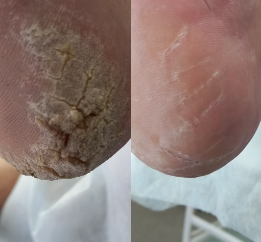 Обработка трещин. Подолог г. Хабаровск — центр здоровой стопы «FOOTTIME»
