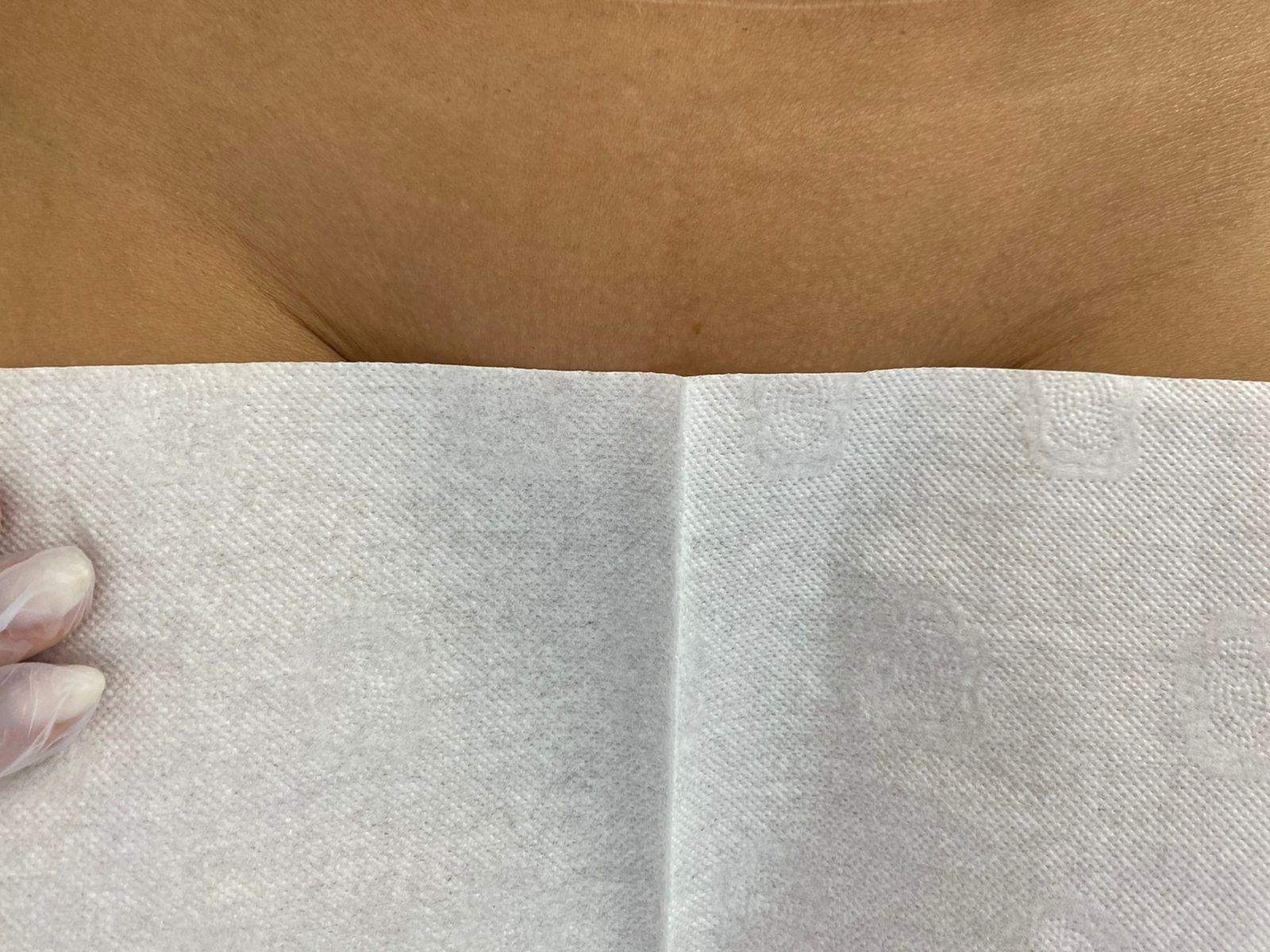 Лазерная эпиляция в г. Кемерово, г. Новокузнецке и г. Киселевске