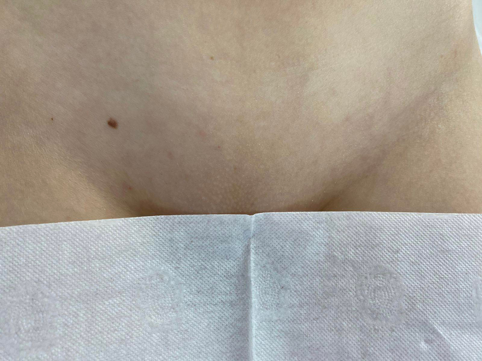 Лазерная эпиляция в г. Кемерово, г. Новокузнецке и г. Киселевске