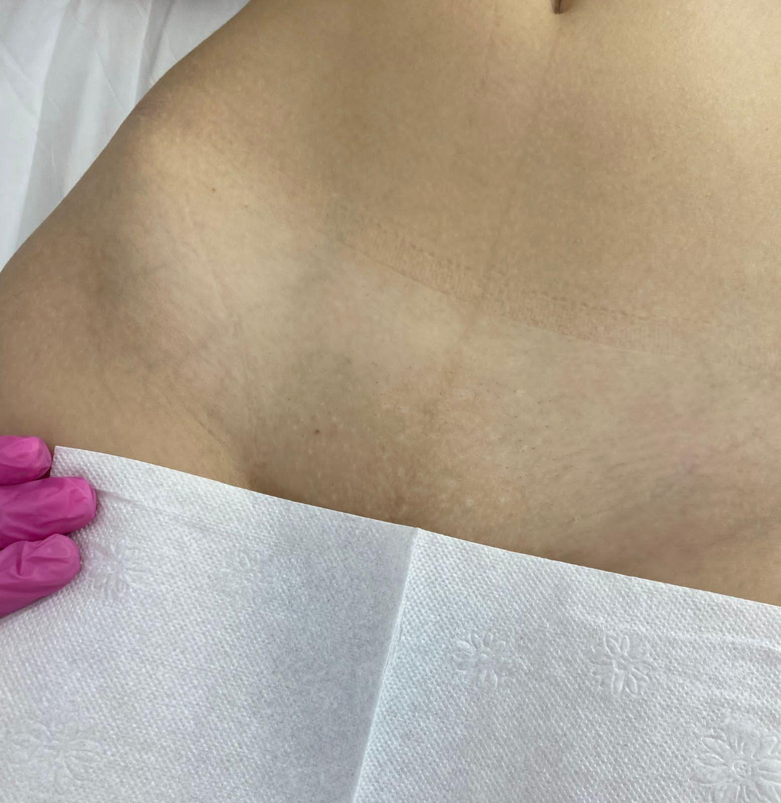 Лазерная эпиляция в г. Кемерово, г. Новокузнецке и г. Киселевске