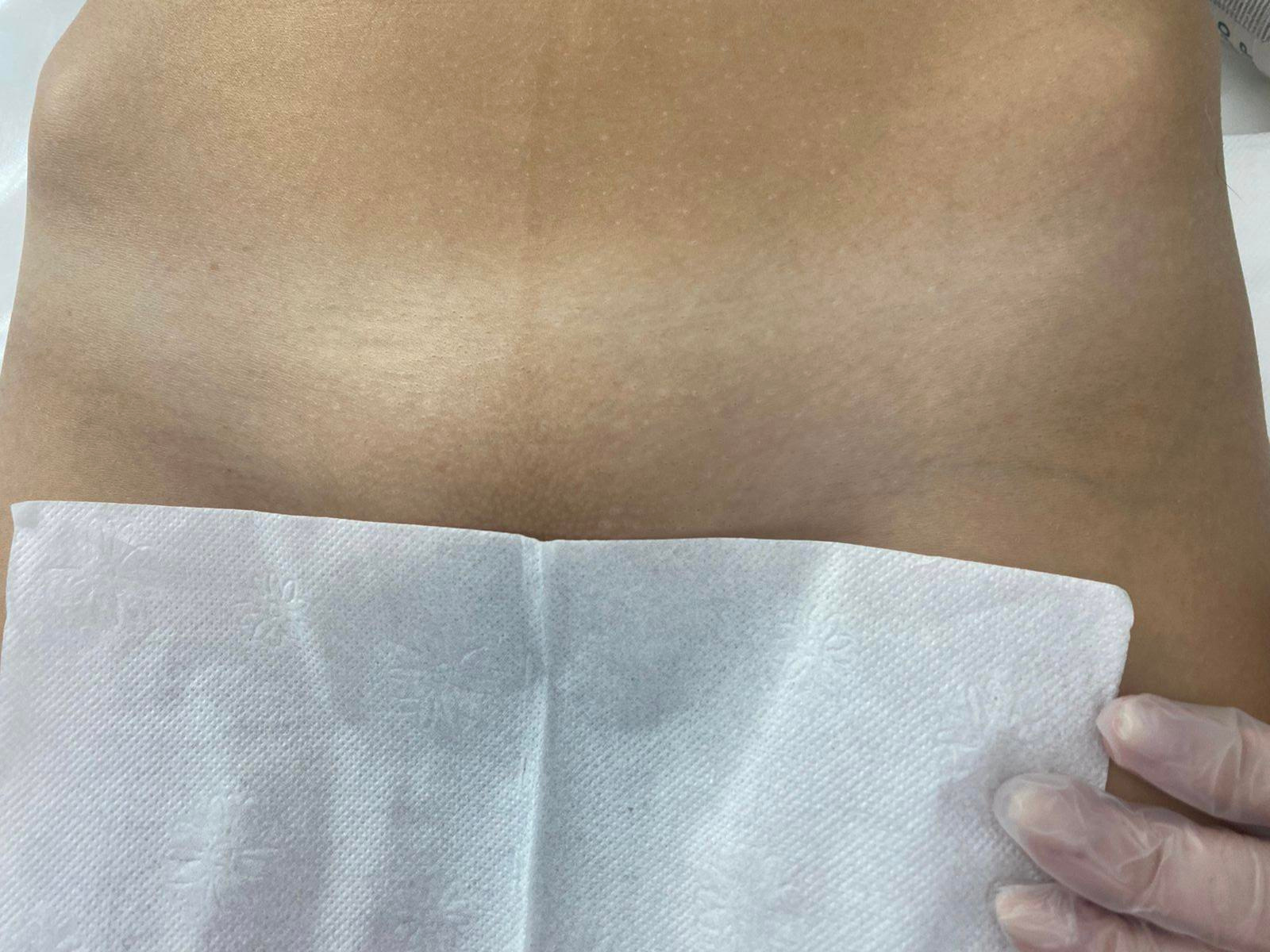 Лазерная эпиляция в г. Кемерово, г. Новокузнецке и г. Киселевске