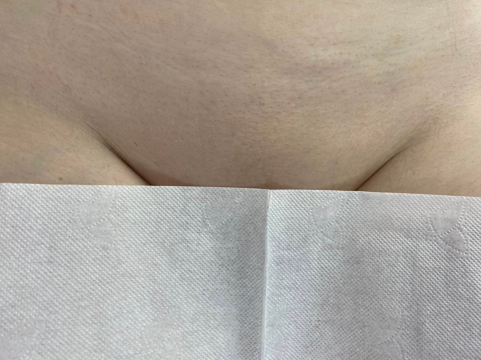 Лазерная эпиляция в г. Кемерово, г. Новокузнецке и г. Киселевске